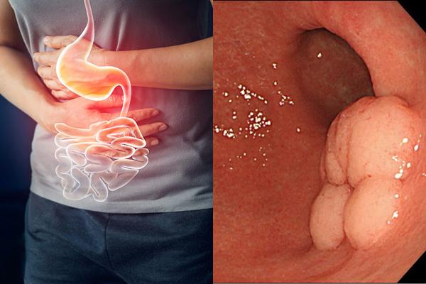 Dấu hiệu ung thư dạ dày giai đoạn đầu