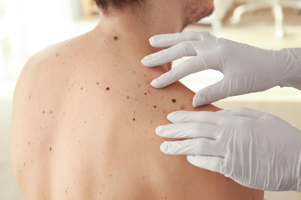 AI có thể chẩn đoán ung thư da chuẩn xác lên tới 96%