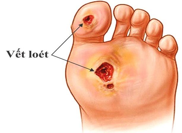 Điều trị đái tháo đường bằng công nghệ nano
