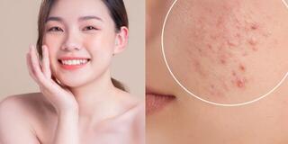 Da dễ sạm, đổ dầu và nổi mụn mùa Hè? Đây là những cách giúp làn da sáng khỏe hơn mỗi ngày