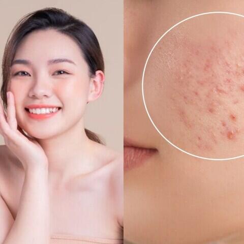 Da dễ sạm, đổ dầu và nổi mụn mùa Hè? Đây là những cách giúp làn da sáng khỏe hơn mỗi ngày